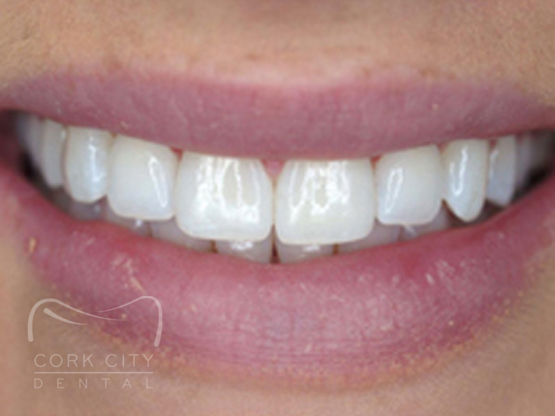 Teeth Whitening - after