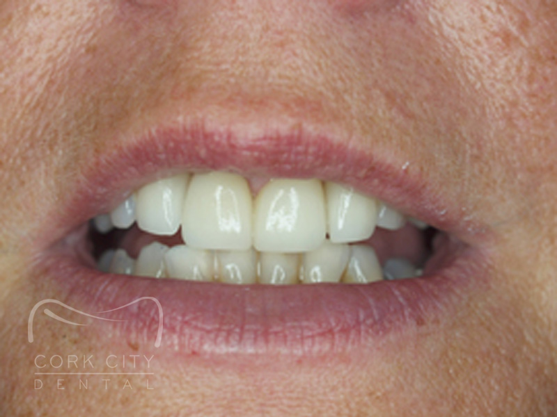 Cosmetic Dentistry - after