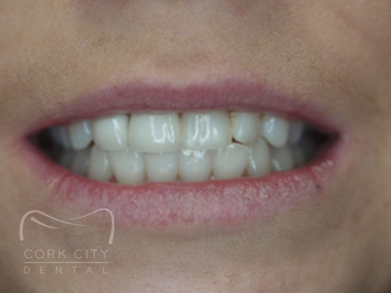 Cosmetic Dentistry - after
