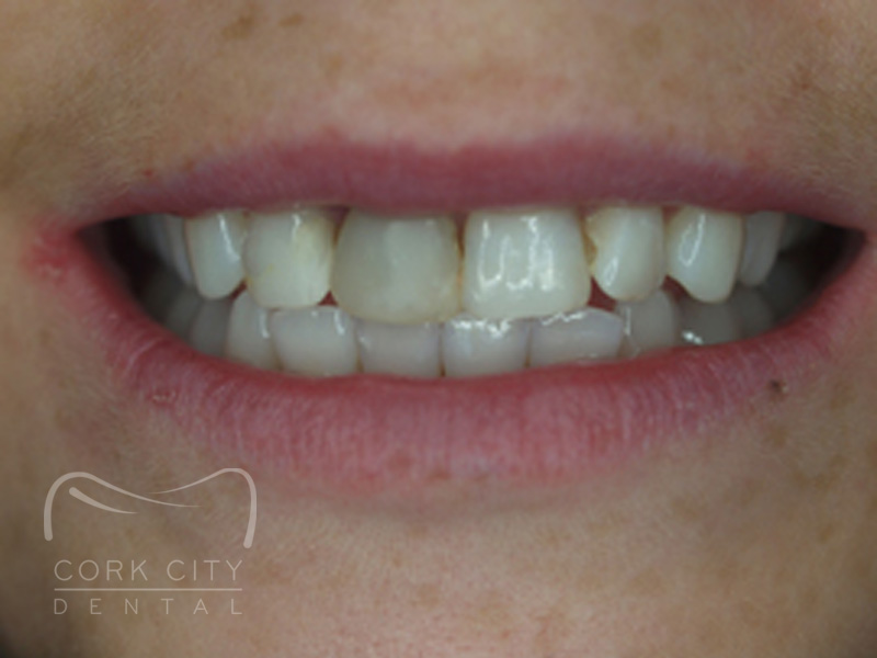 Cosmetic Dentistry - before