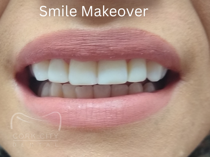 Cork City Dental Smile Makeover